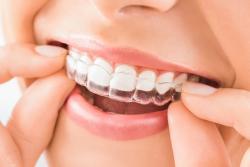 orthodontie en beugels